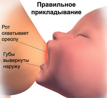 Лактостаз у годуючої матері симптоми і лікування, що не можна робити