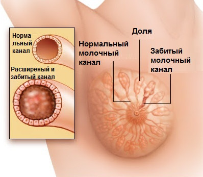 Лактостаз у годуючої матері симптоми і лікування, що не можна робити