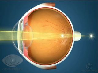Tratamentul cu astigmatism, metode de tratament astigmatism