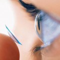 Лікування астигматизму сучасними методами, про хвороби очей