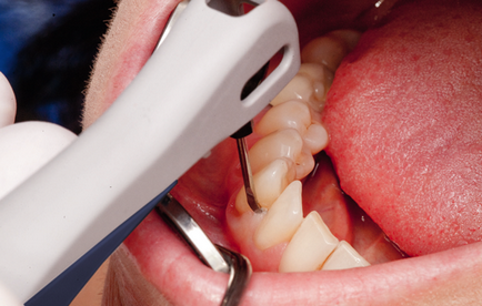 Tratamentul parodontitei - metode, instrumente și medicamente pentru tratamentul mobilității dinților