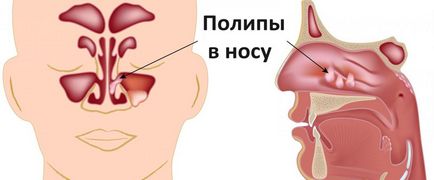 Лікування поліпів в носі без операції як видалити народними засобами, консервативна терапія
