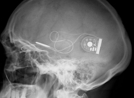 Agyi implantátumok segítségével javítja a memóriát (memória javítására) Agyi implantátumok segítségével javítja a memóriát