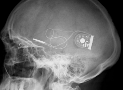 Мозкові імплантати допоможуть поліпшити пам'ять