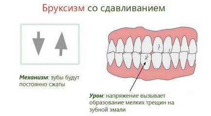 Нічне скреготіння зубами - причини, засоби лікування та наслідки бруксизма у дітей і дорослих