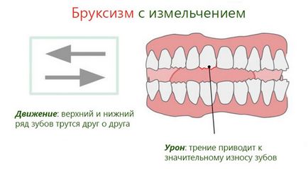 Нічне скреготіння зубами - причини, засоби лікування та наслідки бруксизма у дітей і дорослих