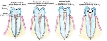 Noe dinți când cauzează sarcină, boli posibile, tratament