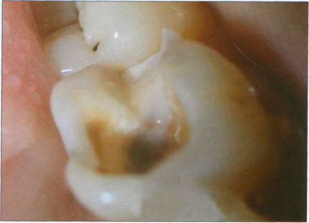 A optikai tulajdonságai a dentin (így) A optikai tulajdonságai dentin