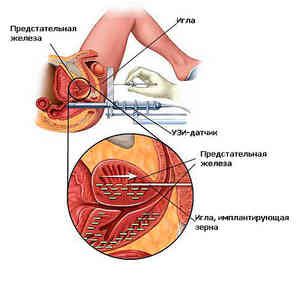 Complicațiile brahiterapiei în cancerul de prostată ce să facă