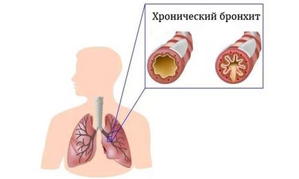 Від якого кашлю зазвичай призначають амбробене дітям і дорослим