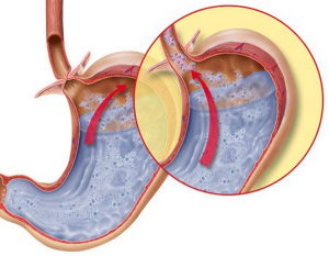 Hernia parazofagiană