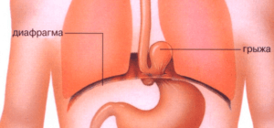 Параезофагеальние грижа стравохідного отвору діафрагми