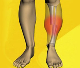 Fractură a semnelor și tratamentului tibiei mari și mici