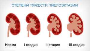 vese pyelectasia mi ez, a 10-es kód és ICD terápia (kezelés) vese pyelectasia mi ez a kód a BNO-10 és a kezelés