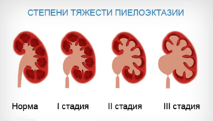 Rinoplaza pieloneziei ceea ce este, codul pentru microbian 10 și tratamentul