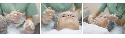 Peeling rosacea tehetünk a bőr (do) Peeling rosacea tehetünk a bőrt