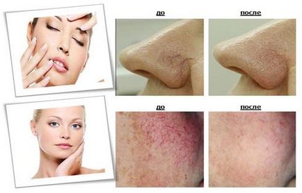 Peeling cu couperose se poate face pentru pielea de pe fata