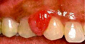 Granulom piogenic al gingiilor - tratamentul granulomului