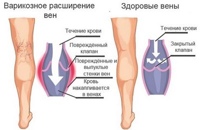 Чому набрякають ноги до вечора можливі причини, що робити