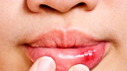 De ce apar leziuni în gură și de ce?