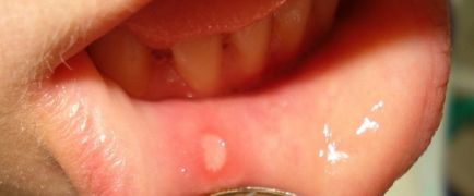 Чому з'являються виразки в роті лікування і причини