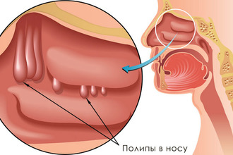 Okai sinusitis felnőtteknél - attól, ami a és van