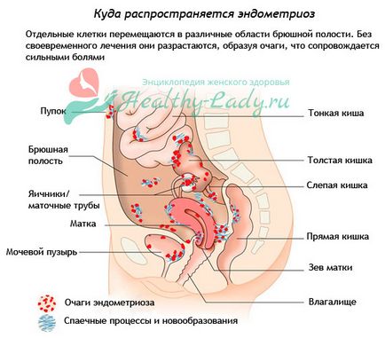 Причини виникнення аденоміозу у жінок - психосоматика, фактори ризику, безпліддя, Луїза Хей