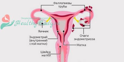 Cauzele adenomiozelor la femei - psihosomatice, factori de risc, infertilitate, louisa hey