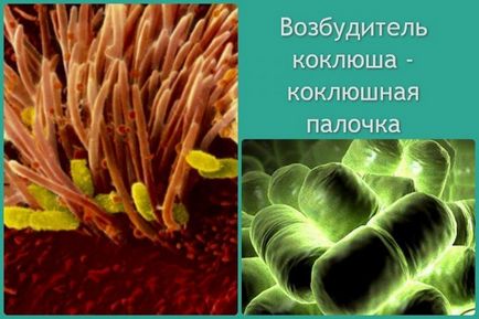 Semne de tuse convulsivă la copil, simptome, caracteristici, video Dr. Komarovsky pe pertussis