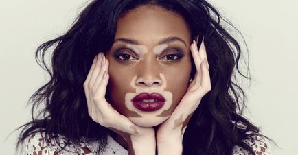 Psychosomatics of vitiligo