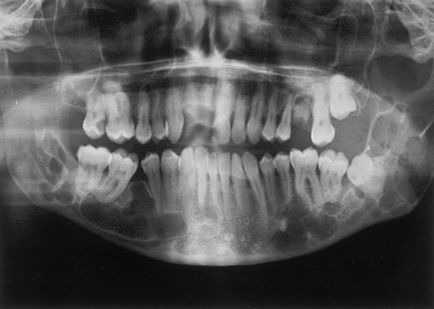 Simptome și tratament pentru cancerul dentar