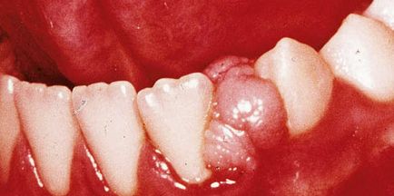 Рак зубів симптоми і лікування