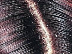 Поширені хвороби волосистої частини голови - симптоми і лікування