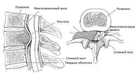 Здавлення спинного мозку симптоми, ознаки, діагностика та лікування