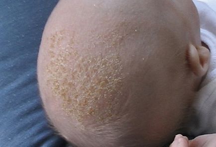 Себорея шкіри голови у дітей причини, симптоми і лікування волосистої частини голови