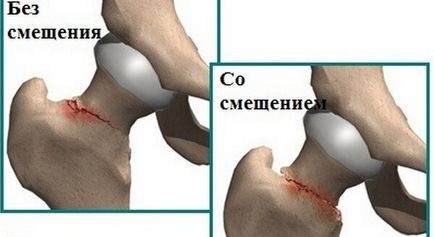 Шийка стегна перелом в літньому віці причини, наслідки, лікування