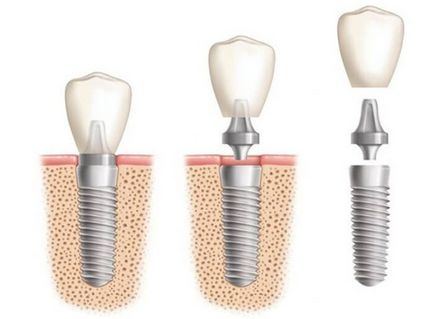 Штифтової зуб переваги штифтового методу протезування