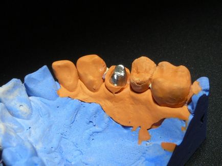 Штифтової зуб переваги штифтового методу протезування