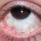 Simblefaron szemek - a leghatékonyabb kezeléseket a moszkvai Eye Clinic
