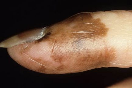 Tünetek és diagnózis rák szöget a láb és a kar