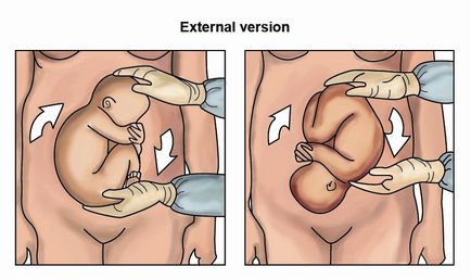 Prezentarea pelviană a cauzelor și diagnosticului fetal