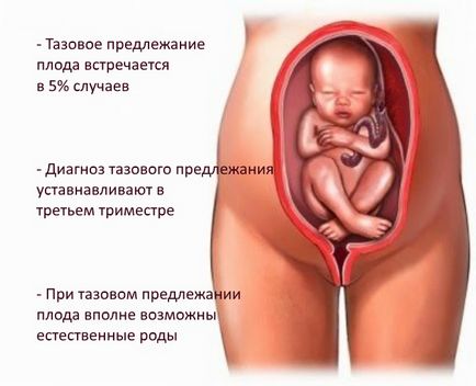 Prezentarea pelviană a cauzelor și diagnosticului fetal