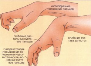 Травми кистей рук і їх лікування