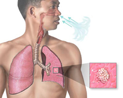 Туберкульоз легень - етапи розвитку та форми