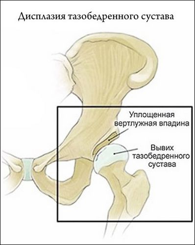 Exerciții pentru prezentarea pelviană a fătului în imagini