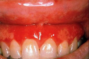 Inflamația gingiilor cauzează, decât tratamentul la domiciliu, antibiotice și unguente
