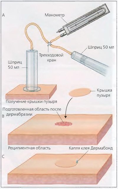 Recuperați pigmentarea cicatricilor cu ajutorul unui laser