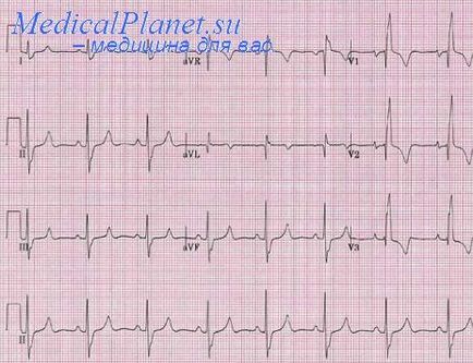 Krónikus pulmonális szív