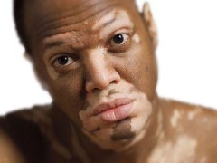 Cauzele bolii de vitiligo, psihosomatice