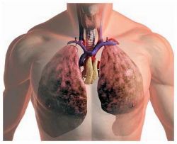 Loturi de boli pulmonare